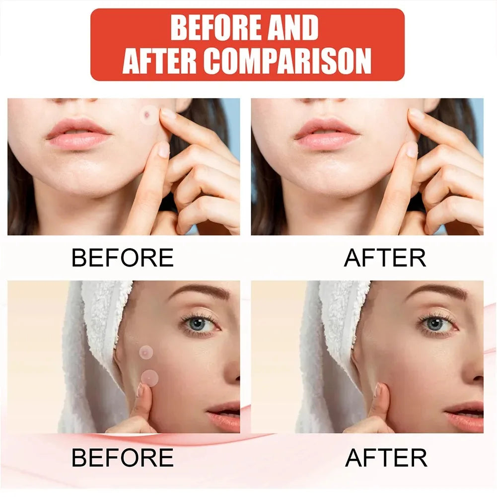 144pcs/set Face High-end Skin Care Pimple Acne Patches Professional Healing Absorbing Spot Sticker Covering for Covering Acne