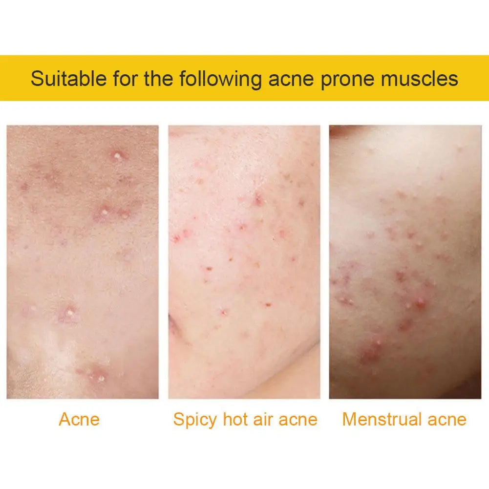 35/40Pcs Colorful Cute Star Heart Shaped Acne Treatment Sticker Invisible Acne Cover Pimple Patch Skin Care