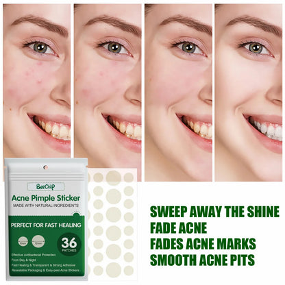 24/36pcs Hydrocolloid Acne Patch Blemish Stickers For Face And Skin Breathable Waterproof Gentle Non-Irritating Acne Stickers