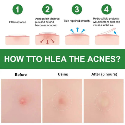 24/36pcs Hydrocolloid Acne Patch Blemish Stickers For Face And Skin Breathable Waterproof Gentle Non-Irritating Acne Stickers