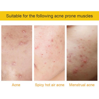35/40Pcs Colorful Cute Star Heart Shaped Acne Treatment Sticker Invisible Acne Cover Pimple Patch Skin Care